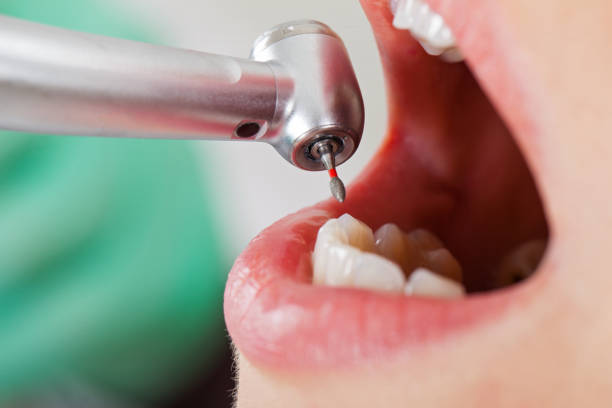 Best Emergency Wisdom Teeth Removal in Clinton, MD